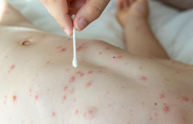 Fake Diagnosis Id For Hives